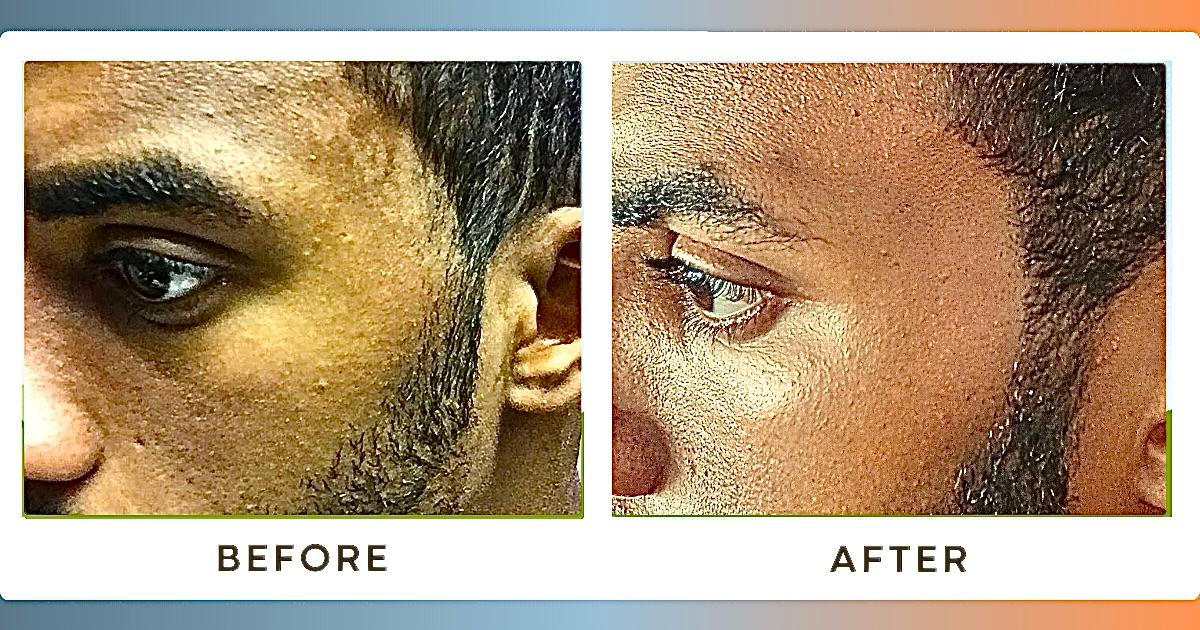 Tinea Versicolor before and after