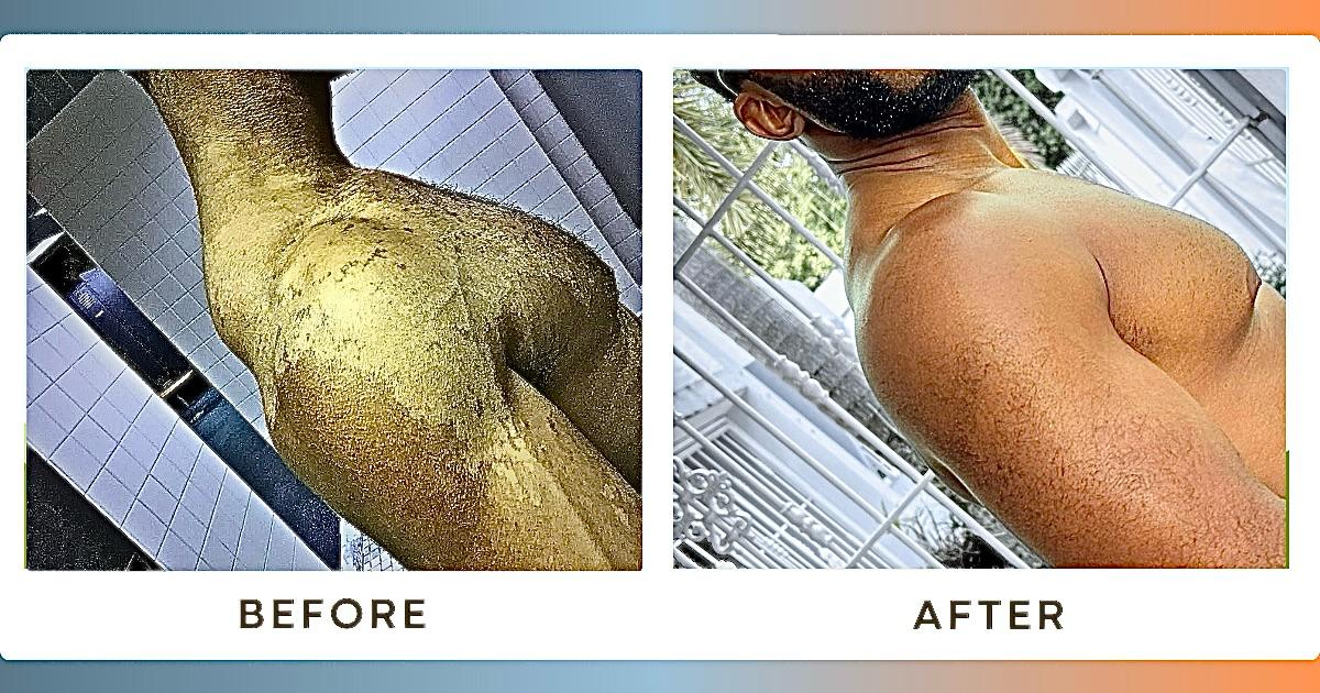 Tinea Versicolor before and after