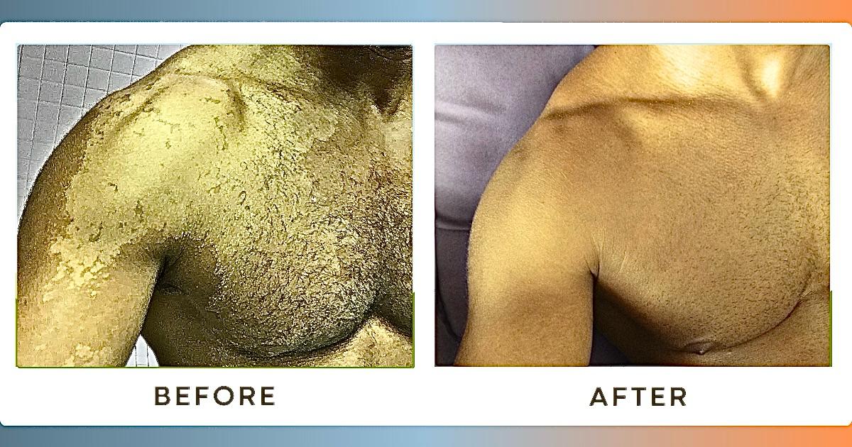 Tinea Versicolor before and after