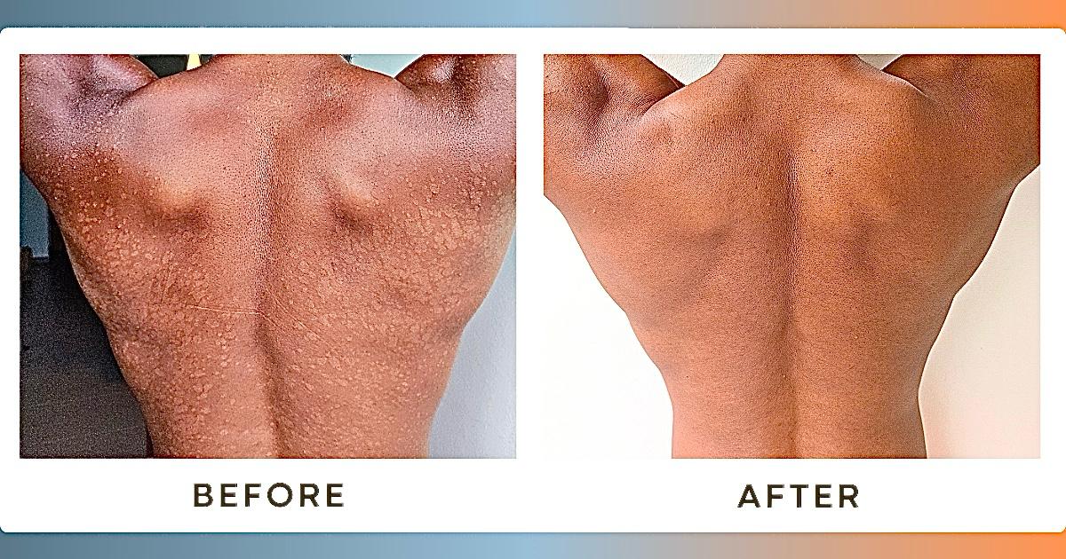 Tinea Versicolor transformation
